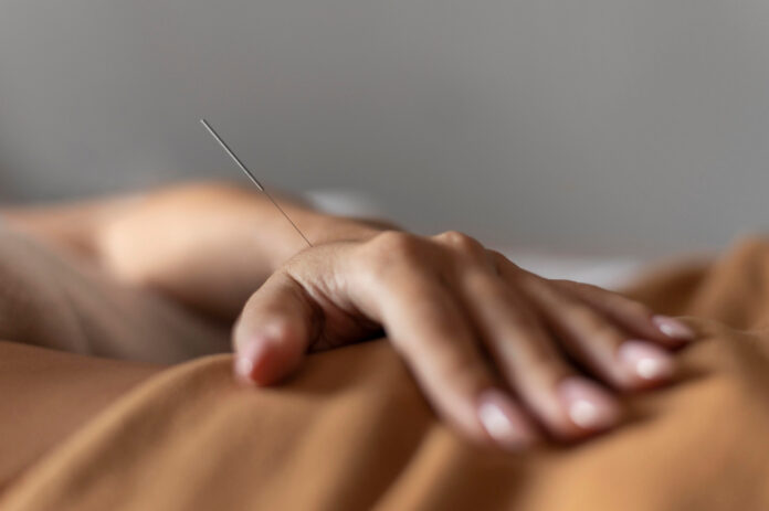 acupunctura